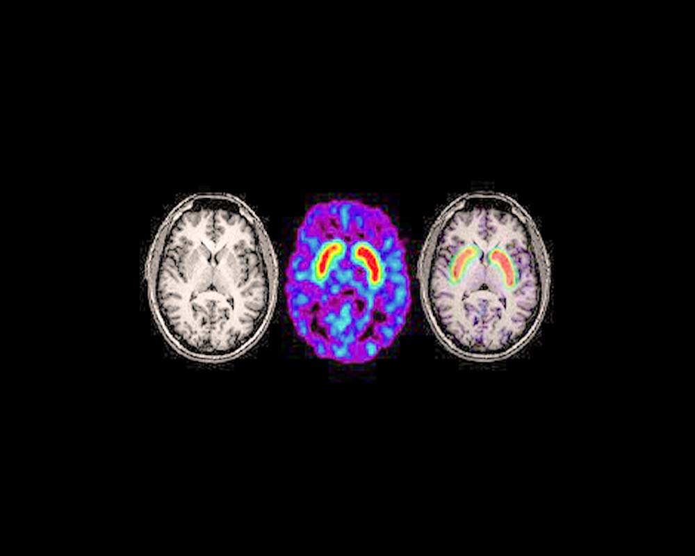 تصویربرداری مغزی MRI و CT Scan