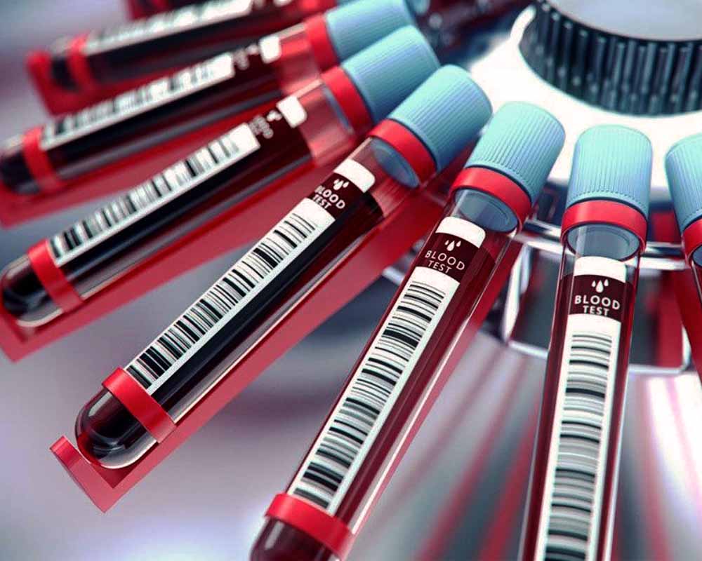 انجام مکرر آزمایش‌های خون در بیماران تحت دیالیز