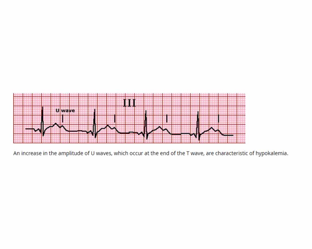 آریتمی‌های قلبی و اختلالات ECG